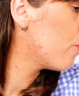 Cicatrici atrofiche da acne, revisione Cochrane non individua un trattamento ideale